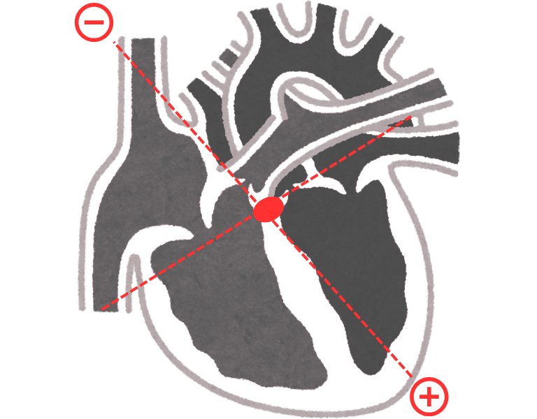 Complete ventricular depolarization and QRS vectors (formation of QRS complex)