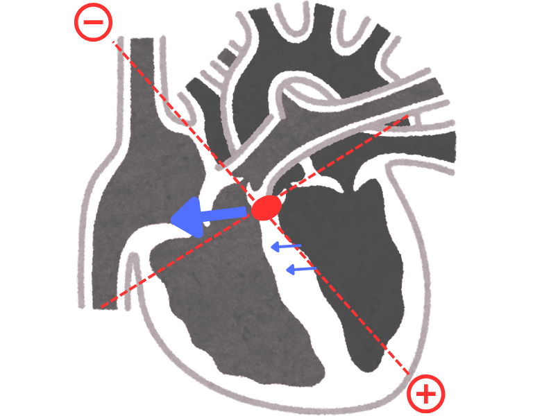 vector direction in septal depolarization (formation of Q wave)